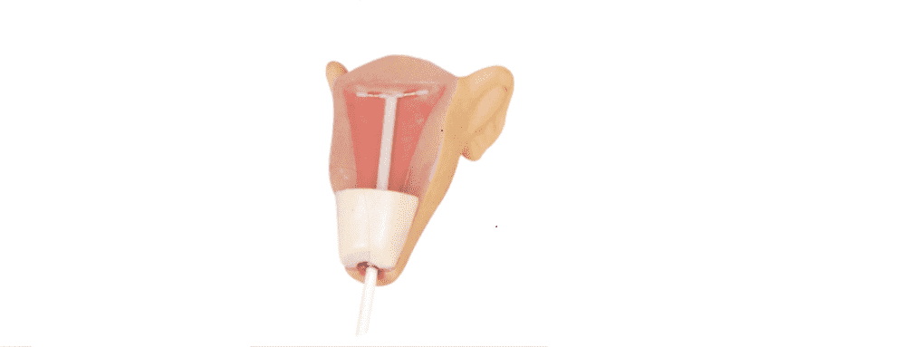 IUD Insertion Model II